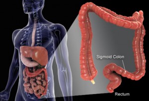 colon cancer