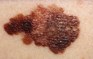skin cancer treatment naples