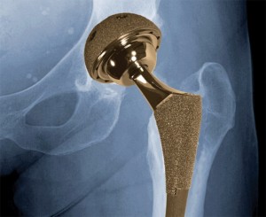 Know About Metal on Metal Hip Implants