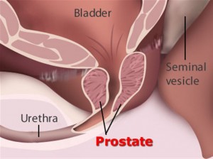 Prostate Cancer