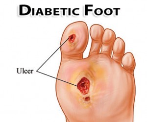 Diabetic Foot