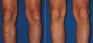 Top 6 Reasons to Get Your Leg Vein Evaluation and Treatment this FALL