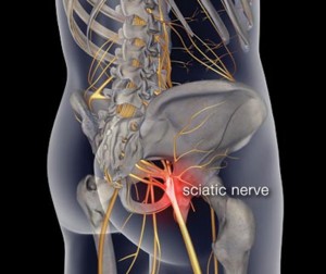 Sciatica & Leg Pain… You don’t have to suffer