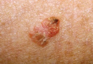 WHAT IS AN ACTINIC KERATOSIS
