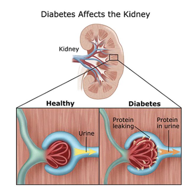 DIABETES AND KIDNEY DISEASE – Southwest Florida's Health and Wellness  Magazine