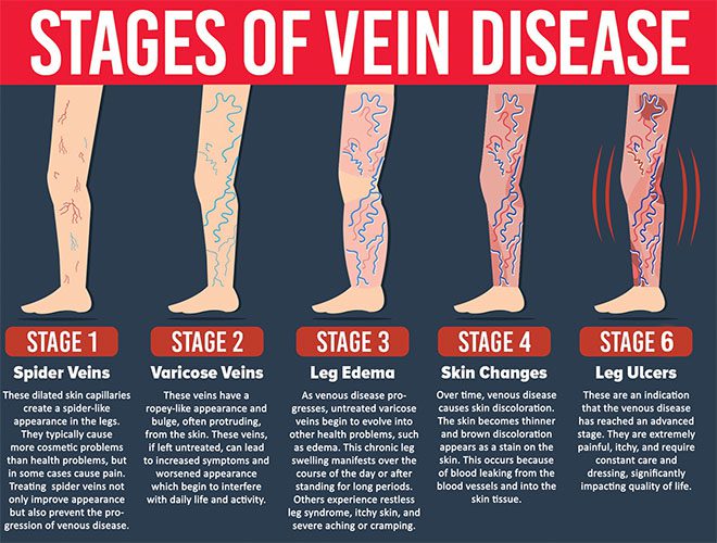 Venous Disease