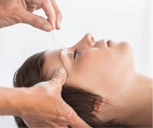 Facial Cosmetic Acupuncture 