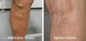 Spider & Varicose Veins